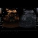 Renal carcinoma, treatment with RFA, follow-up, CEUS: US - Ultrasound